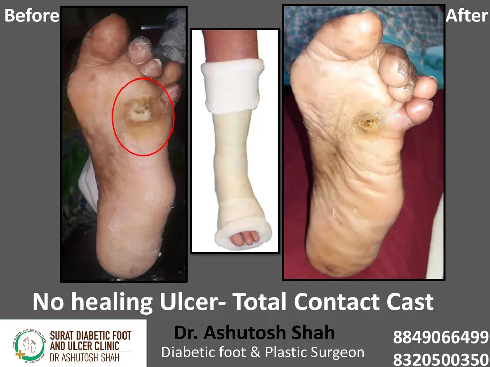 Diabetic Foot  PPT 3 checked by sir.pptx-60.webp